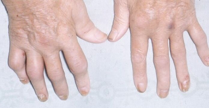 artropatska psoriaza na rokah
