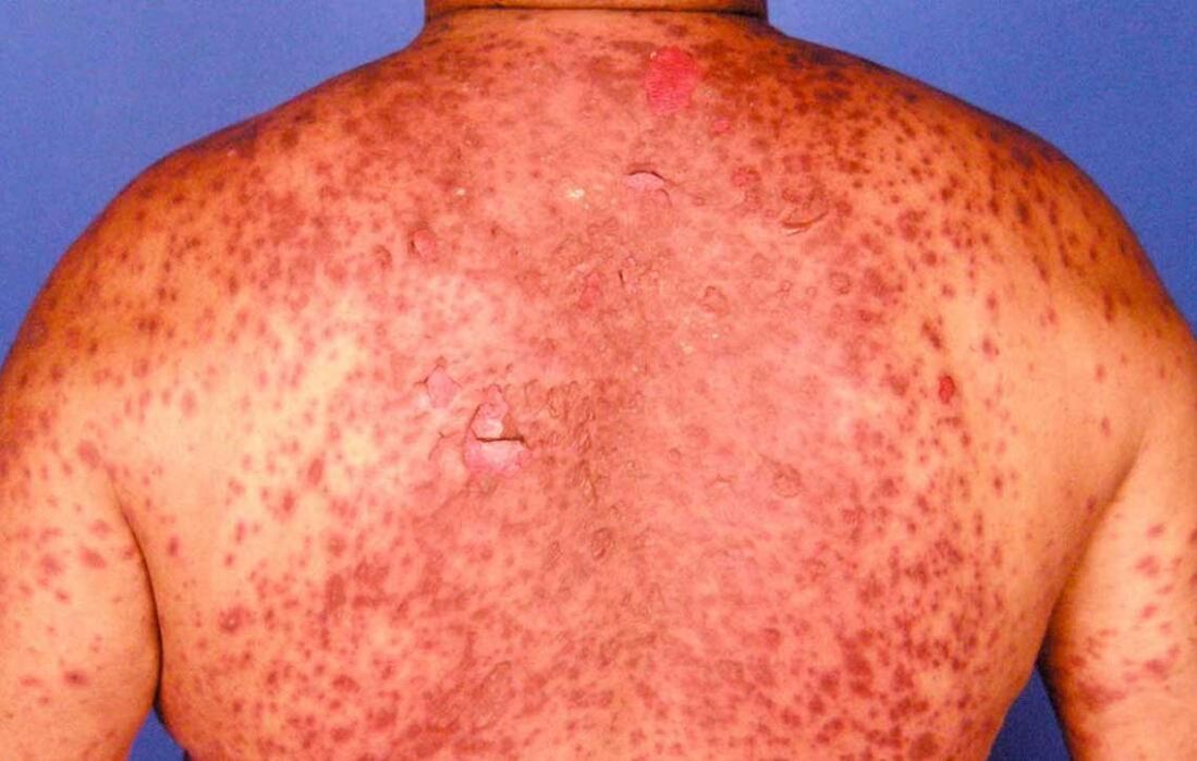 psoriatična eritroderma na hrbtu