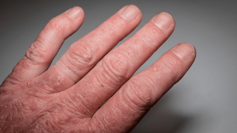 psoriatični artritis na rokah