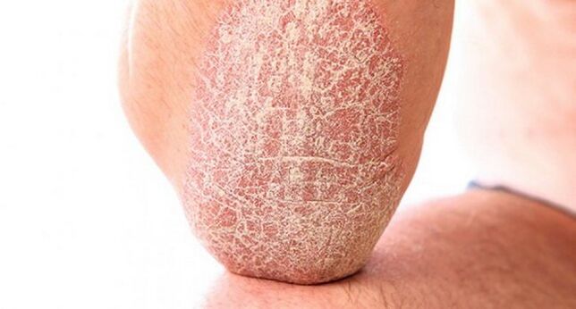 psoriasis vulgaris na koži