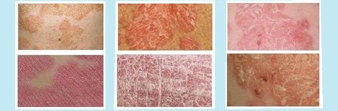 Kožni izpuščaji, značilni za različne vrste psoriaze