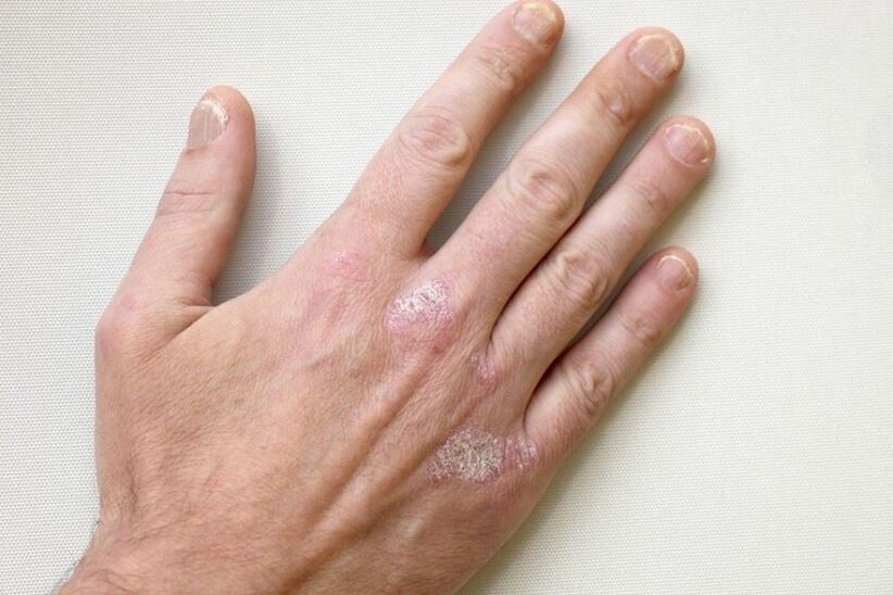 Obvezen simptom luskavice so plaki z luskami na koži
