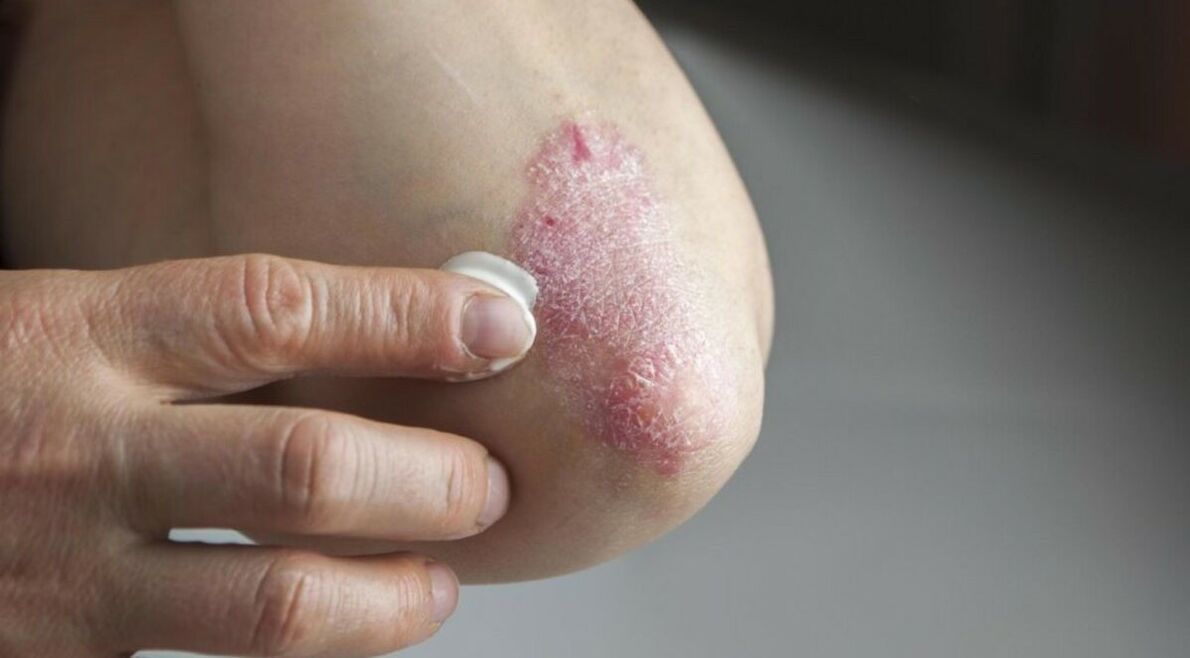 Psoriaza, ki prizadene kožo, katere zdravljenje vključuje uporabo mazil