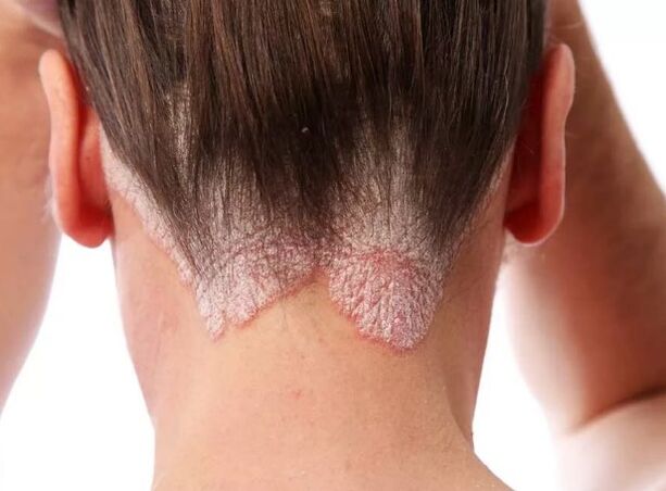 Psoriatična eritroderma
