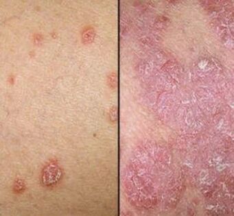 Psoriatične plakete