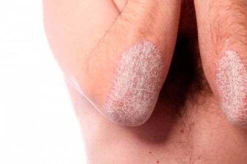 Psoriaza na komolcih