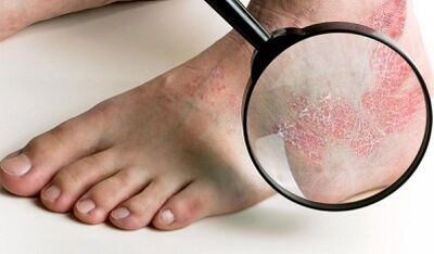 možnosti zdravljenja psoriaze