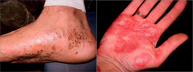 Palmoplantarna psoriaza