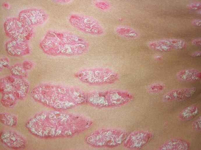 psoriaza v plakih