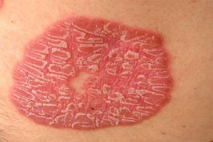 pustularna psoriaza