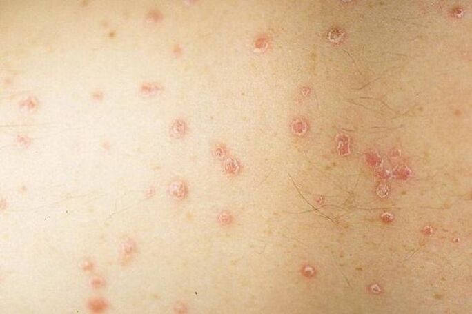 simptomi pikčaste psoriaze