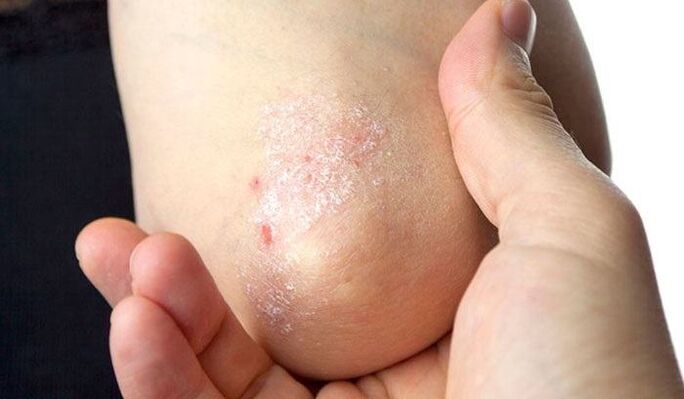 simptomi psoriaze v začetni fazi