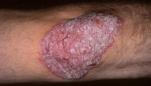 psoriaza